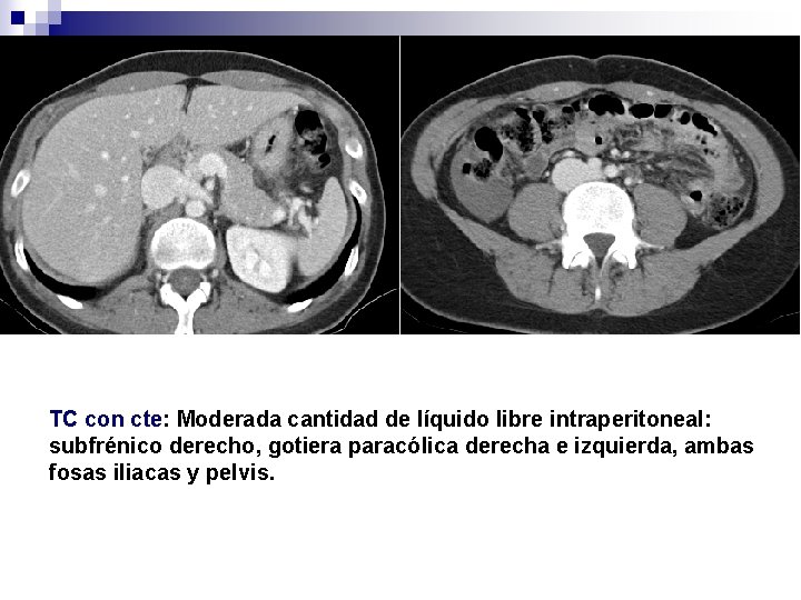 TC con cte: Moderada cantidad de líquido libre intraperitoneal: subfrénico derecho, gotiera paracólica derecha