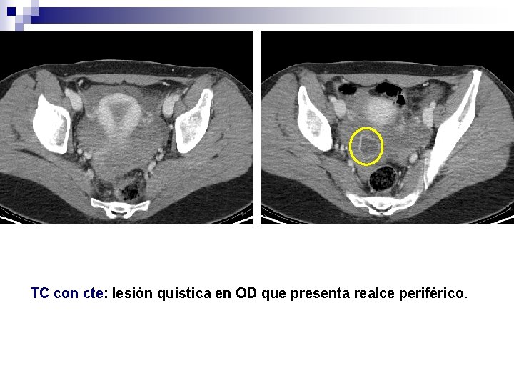 TC con cte: lesión quística en OD que presenta realce periférico. 