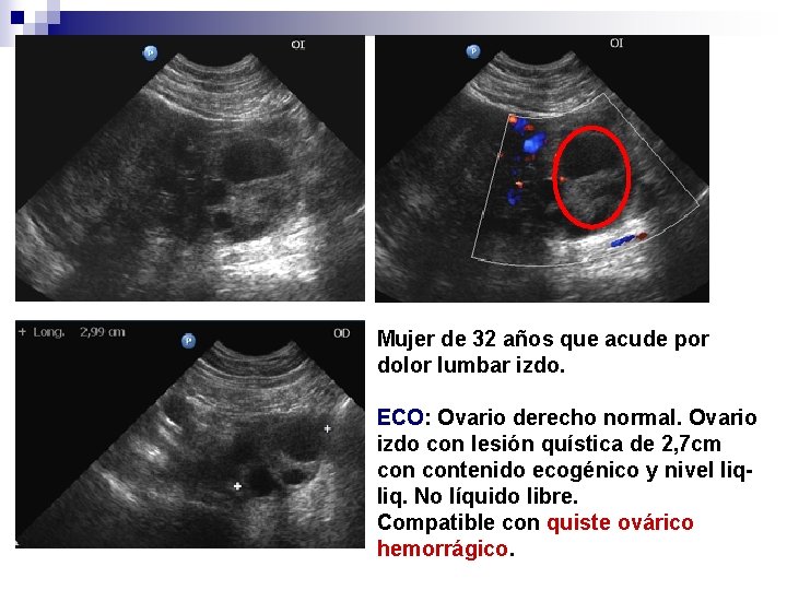 Mujer de 32 años que acude por dolor lumbar izdo. ECO: Ovario derecho normal.