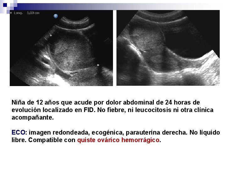 Niña de 12 años que acude por dolor abdominal de 24 horas de evolución