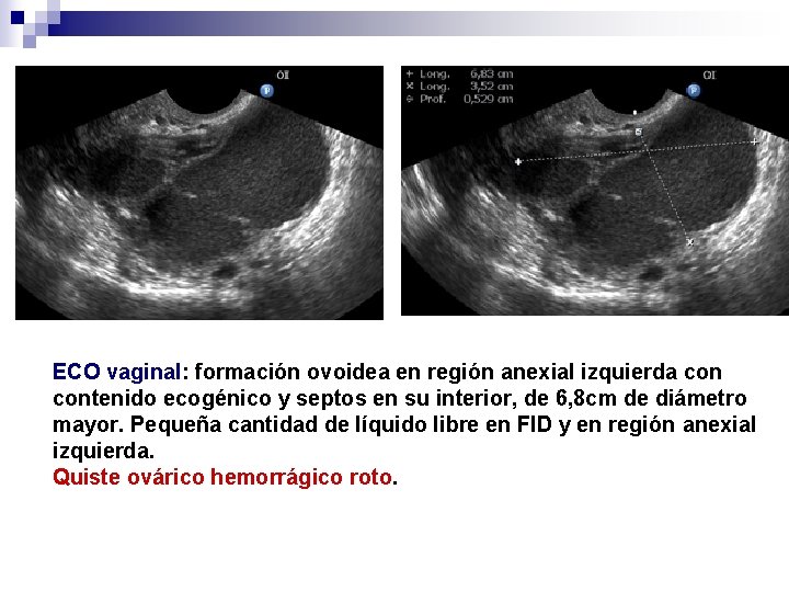 ECO vaginal: formación ovoidea en región anexial izquierda contenido ecogénico y septos en su