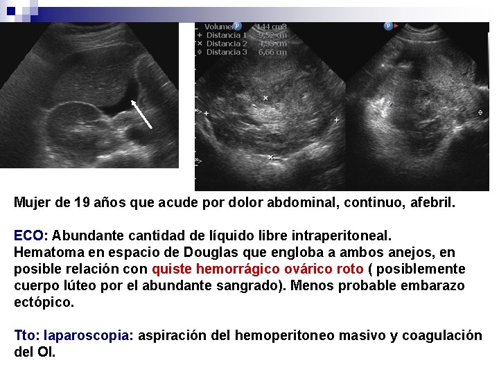 Mujer de 19 años que acude por dolor abdominal, continuo, afebril. ECO: Abundante cantidad