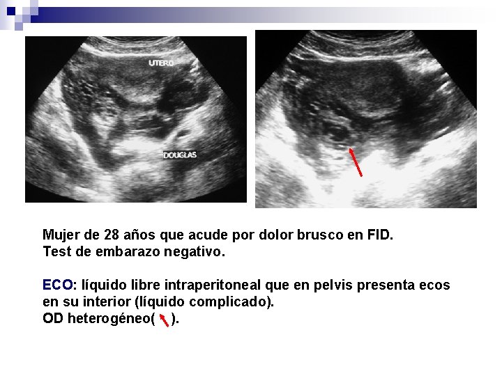 Mujer de 28 años que acude por dolor brusco en FID. Test de embarazo