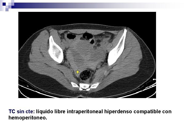 TC sin cte: líquido libre intraperitoneal hiperdenso compatible con hemoperitoneo. 