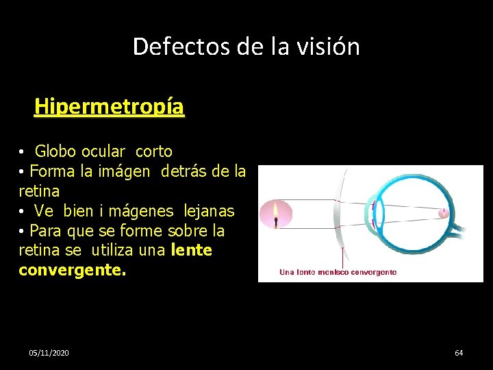 Defectos de la visión Hipermetropía • Globo ocular corto • Forma la imágen detrás