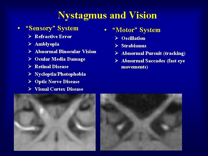 Nystagmus and Vision • “Sensory” System Ø Ø Ø Ø Refractive Error Amblyopia Abnormal