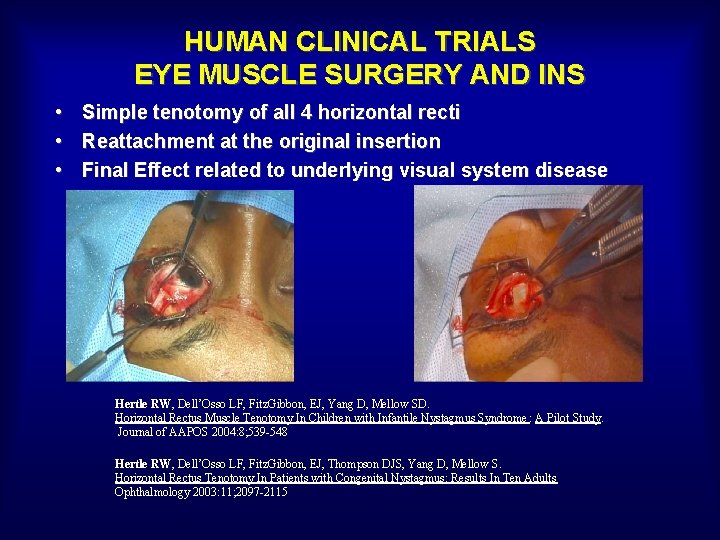 HUMAN CLINICAL TRIALS EYE MUSCLE SURGERY AND INS • • • Simple tenotomy of