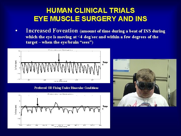 HUMAN CLINICAL TRIALS EYE MUSCLE SURGERY AND INS • Increased Foveation (amount of time