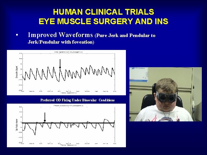 HUMAN CLINICAL TRIALS EYE MUSCLE SURGERY AND INS • Improved Waveforms (Pure Jerk and