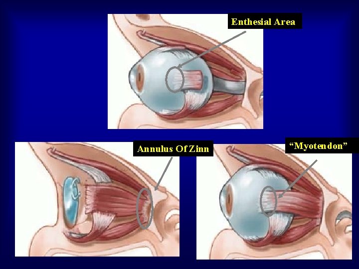 Enthesial Area Annulus Of Zinn “Myotendon” 