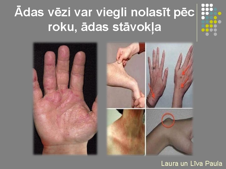 Ādas vēzi var viegli nolasīt pēc roku, ādas stāvokļa Laura un Līva Paula 