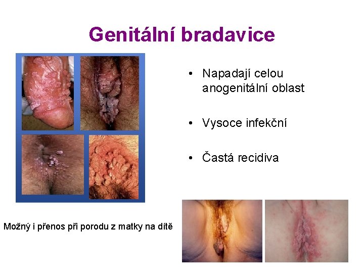 Genitální bradavice • Napadají celou anogenitální oblast • Vysoce infekční • Častá recidiva Možný