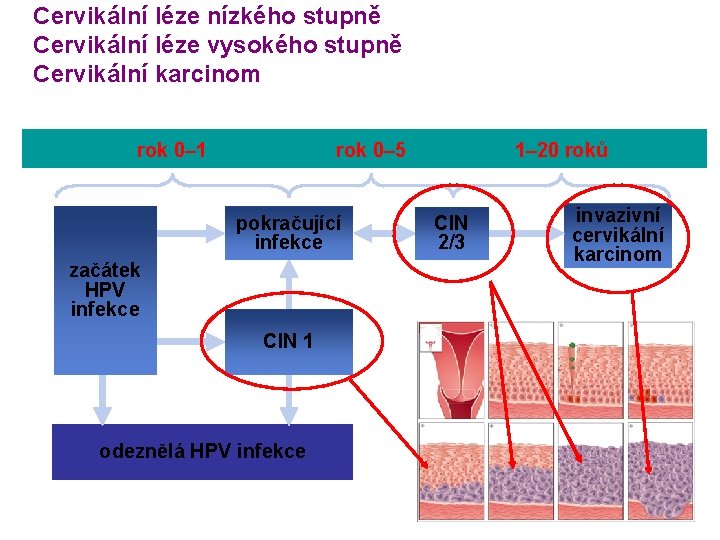  Cervikální léze nízkého stupně Cervikální léze vysokého stupně Cervikální karcinom rok 0– 1