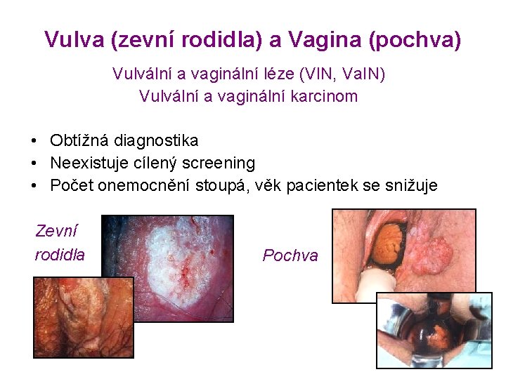 Vulva (zevní rodidla) a Vagina (pochva) Vulvální a vaginální léze (VIN, Va. IN) Vulvální