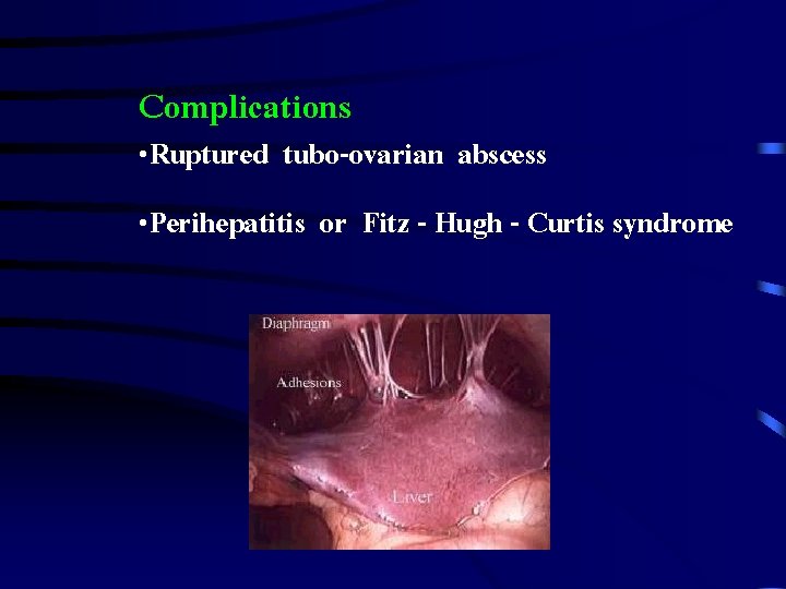 Complications • Ruptured tubo-ovarian abscess • Perihepatitis or Fitz - Hugh - Curtis syndrome