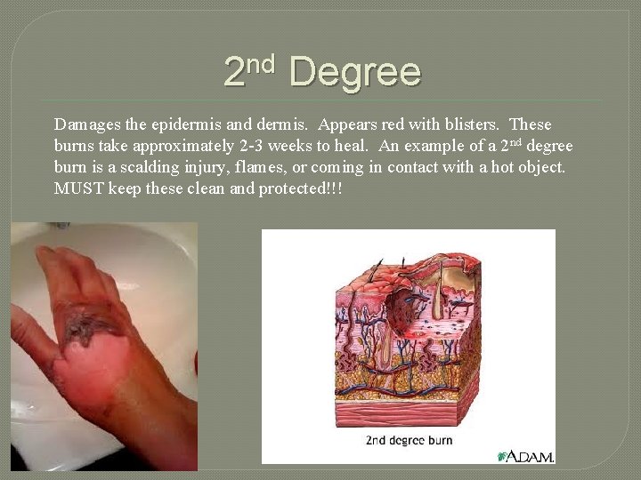 2 nd Degree Damages the epidermis and dermis. Appears red with blisters. These burns