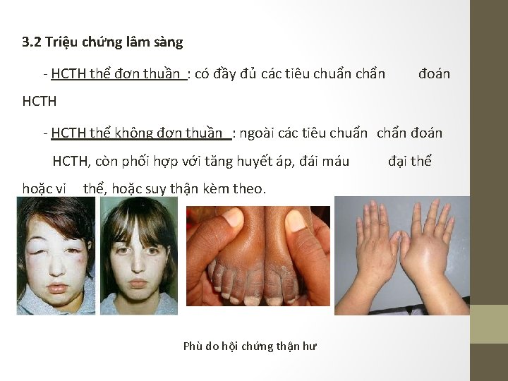 3. 2 Triệu chứng lâm sàng - HCTH thể đơn thuần : có đầy