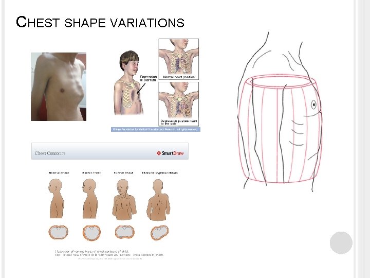 CHEST SHAPE VARIATIONS 