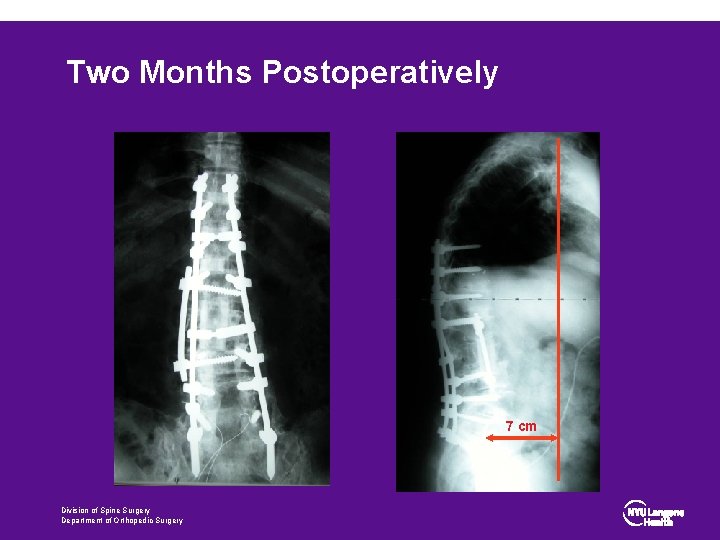 Two Months Postoperatively 7 cm Division of Spine Surgery Department of Orthopedic Surgery 