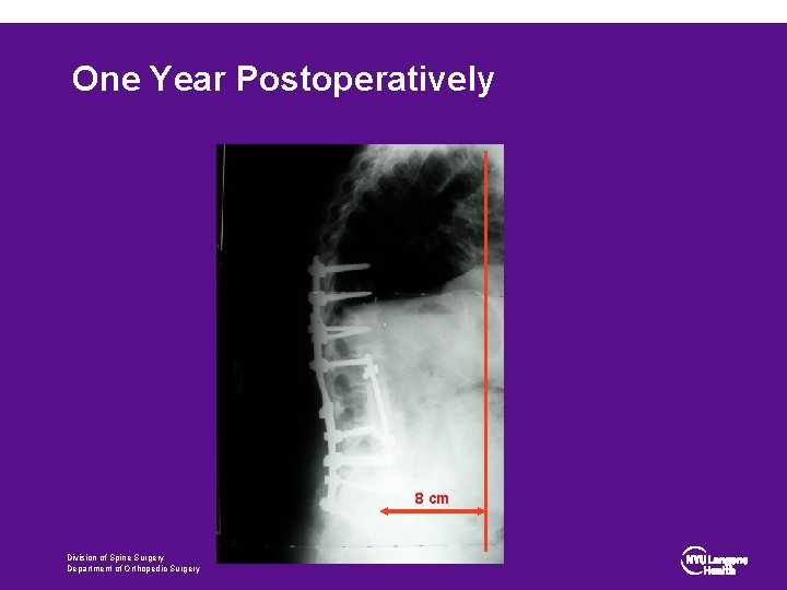 One Year Postoperatively 8 cm Division of Spine Surgery Department of Orthopedic Surgery 