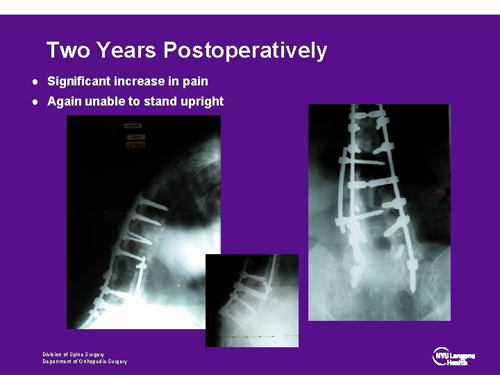 Two Years Postoperatively ● Significant increase in pain ● Again unable to stand upright