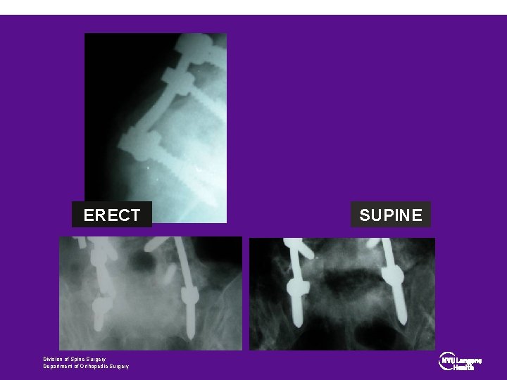 ERECT Division of Spine Surgery Department of Orthopedic Surgery SUPINE 