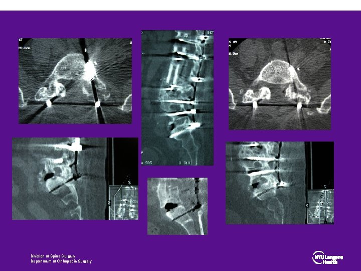 Division of Spine Surgery Department of Orthopedic Surgery 