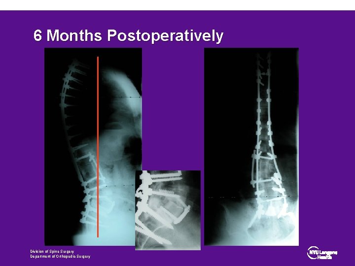 6 Months Postoperatively Division of Spine Surgery Department of Orthopedic Surgery 