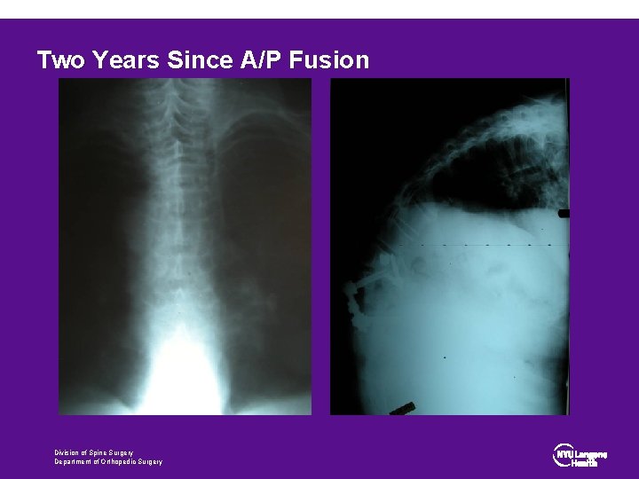 Two Years Since A/P Fusion Division of Spine Surgery Department of Orthopedic Surgery 