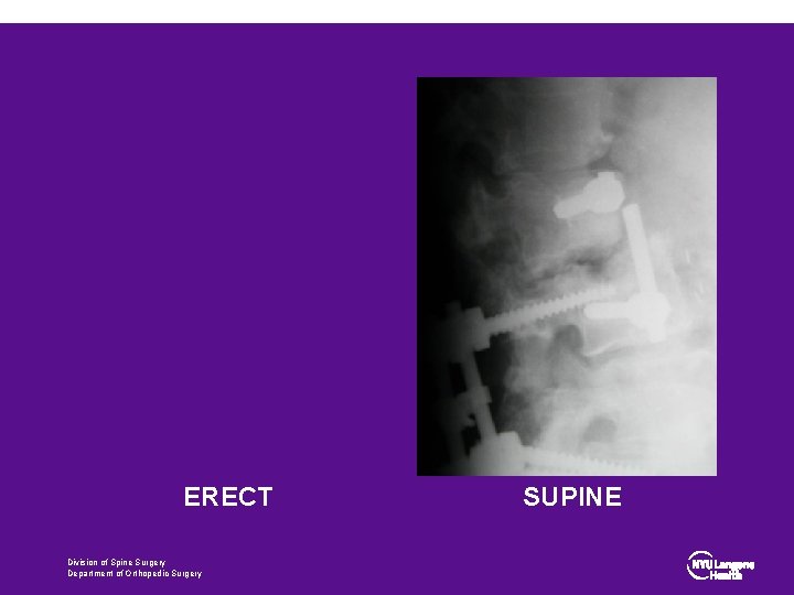 ERECT Division of Spine Surgery Department of Orthopedic Surgery SUPINE 