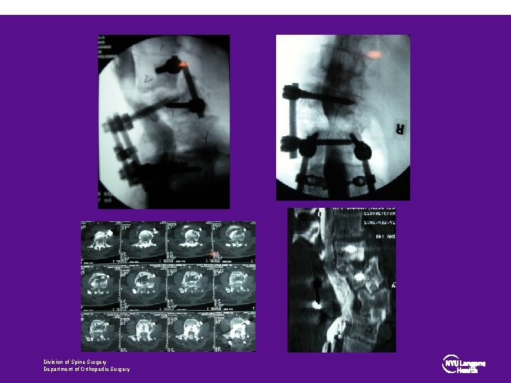 Division of Spine Surgery Department of Orthopedic Surgery 
