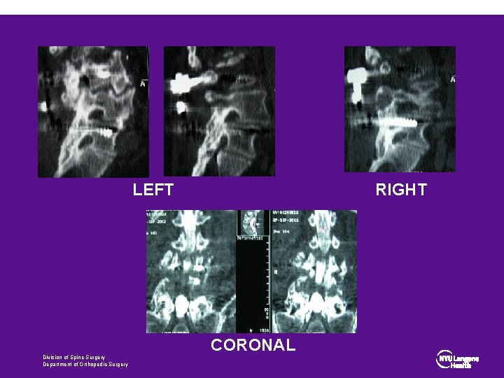 LEFT RIGHT CORONAL Division of Spine Surgery Department of Orthopedic Surgery 