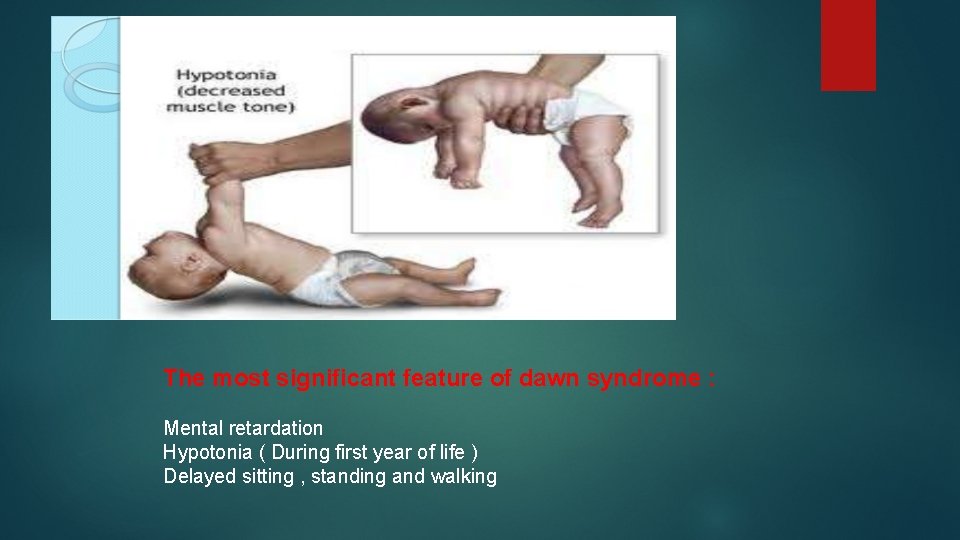 The most significant feature of dawn syndrome : Mental retardation Hypotonia ( During first