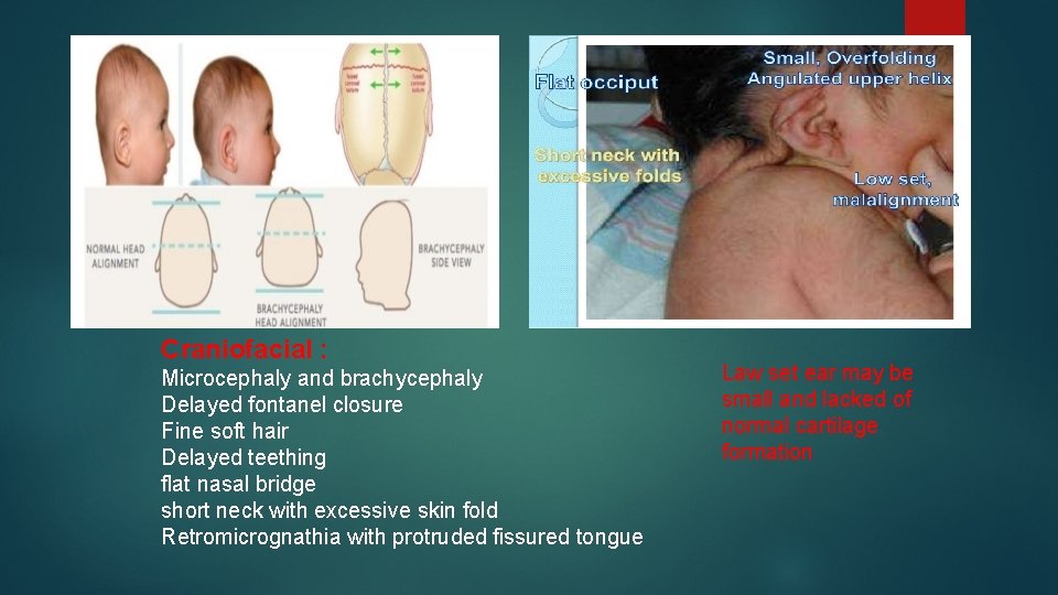 Craniofacial : Microcephaly and brachycephaly Delayed fontanel closure Fine soft hair Delayed teething flat