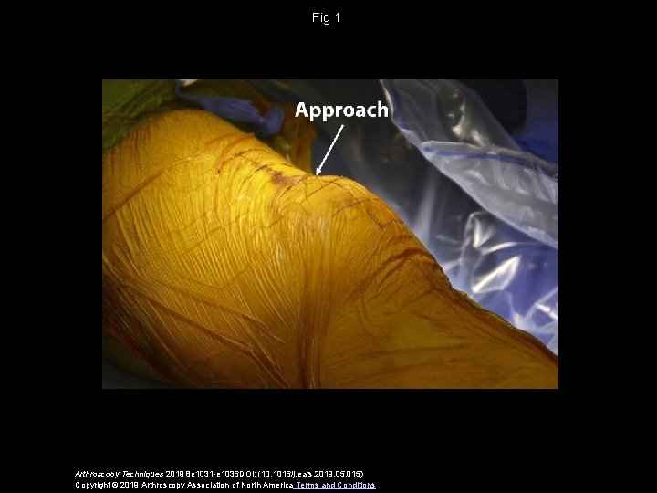 Fig 1 Arthroscopy Techniques 2019 8 e 1031 -e 1036 DOI: (10. 1016/j. eats.