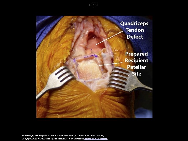 Fig 3 Arthroscopy Techniques 2019 8 e 1031 -e 1036 DOI: (10. 1016/j. eats.