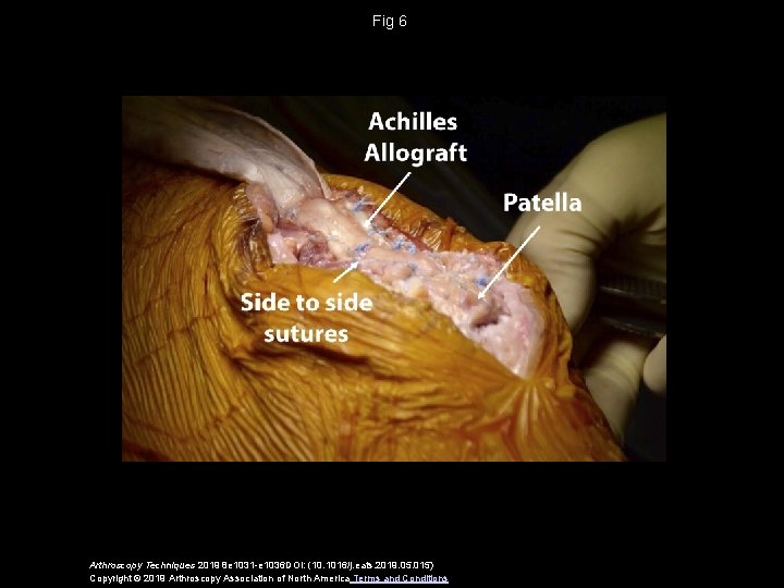 Fig 6 Arthroscopy Techniques 2019 8 e 1031 -e 1036 DOI: (10. 1016/j. eats.