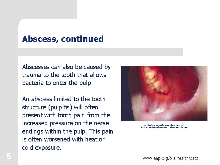 Eruption Abscess Protecting All Childrens Teeth Common Oral Pathology 1
