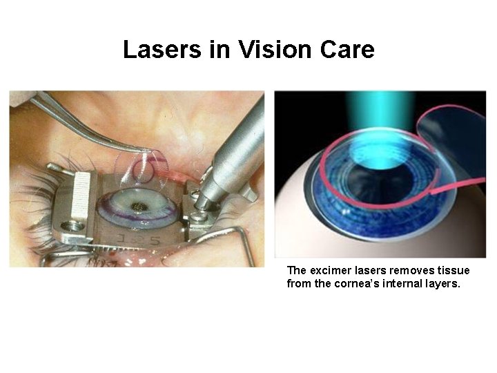 Lasers in Vision Care The excimer lasers removes tissue from the cornea’s internal layers.