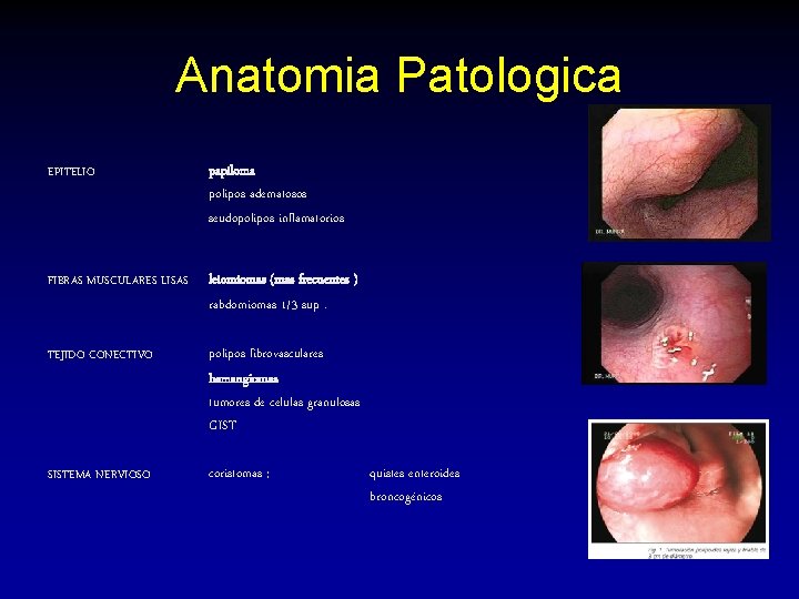 Anatomia Patologica EPITELIO papiloma polipos adematosos seudopolipos inflamatorios FIBRAS MUSCULARES LISAS leiomiomas (mas frecuentes Anatomia Patologica EPITELIO papiloma polipos adematosos seudopolipos inflamatorios FIBRAS MUSCULARES LISAS leiomiomas (mas frecuentes