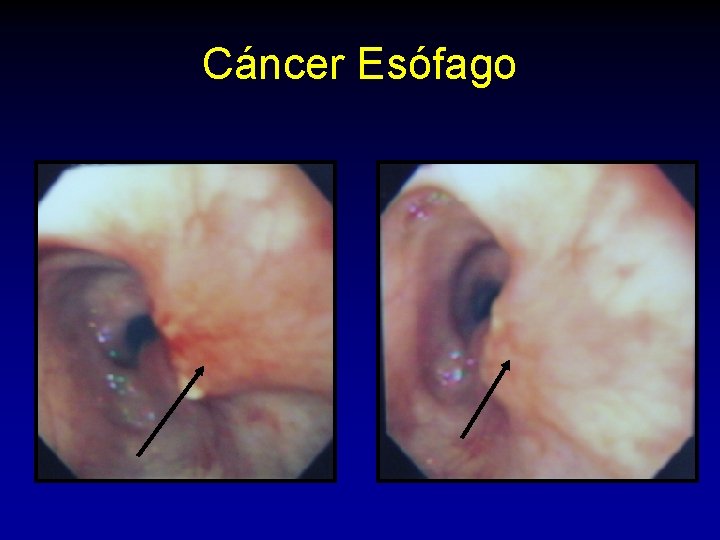 Cáncer Esófago Cáncer Esófago