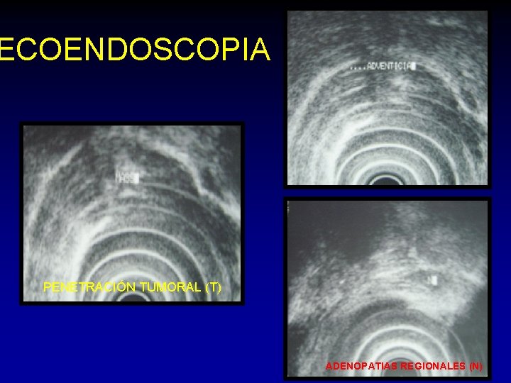 ECOENDOSCOPIA PENETRACIÓN TUMORAL (T) ADENOPATIAS REGIONALES (N) ECOENDOSCOPIA PENETRACIÓN TUMORAL (T) ADENOPATIAS REGIONALES (N)