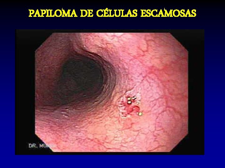 PAPILOMA DE CÉLULAS ESCAMOSAS PAPILOMA DE CÉLULAS ESCAMOSAS