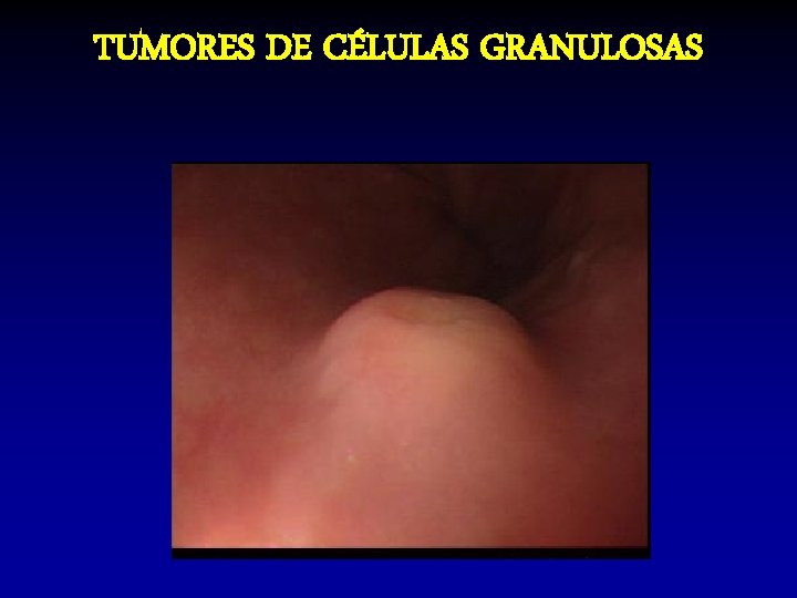 TUMORES DE CÉLULAS GRANULOSAS TUMORES DE CÉLULAS GRANULOSAS