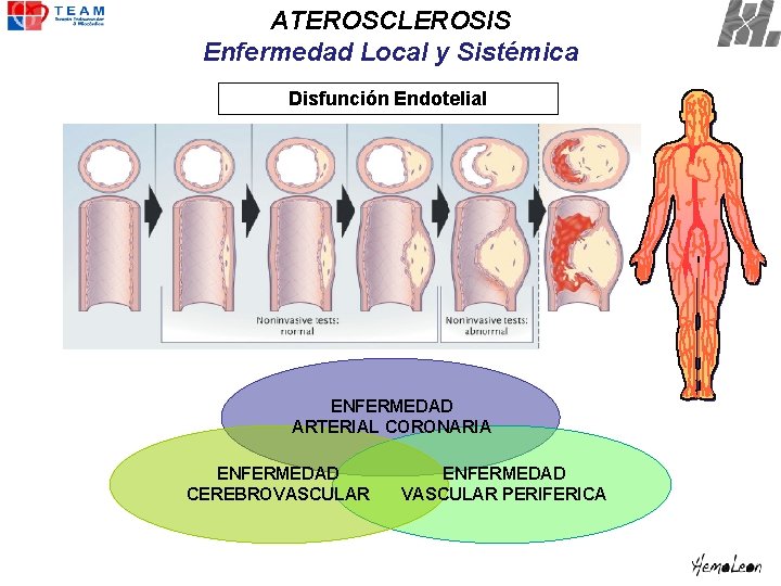 ATEROSCLEROSIS Enfermedad Local y Sistémica Disfunción Endotelial ENFERMEDAD ARTERIAL CORONARIA ENFERMEDAD CEREBROVASCULAR ENFERMEDAD VASCULAR