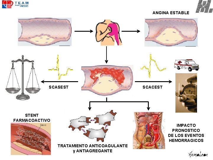 ANGINA ESTABLE SCASEST SCACEST STENT FARMACOACTIVO IMPACTO PRONOSTICO DE LOS EVENTOS HEMORRAGICOS TRATAMIENTO ANTICOAGULANTE