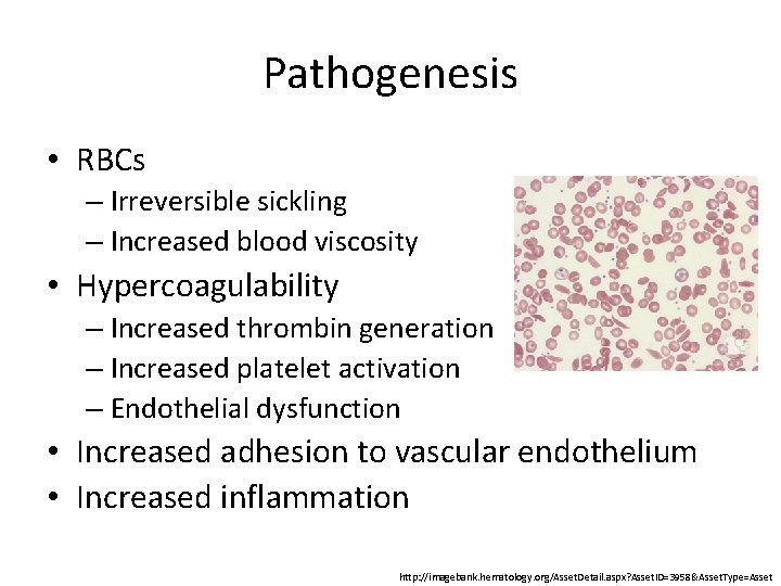 Pathogenesis • RBCs – Irreversible sickling – Increased blood viscosity • Hypercoagulability – Increased