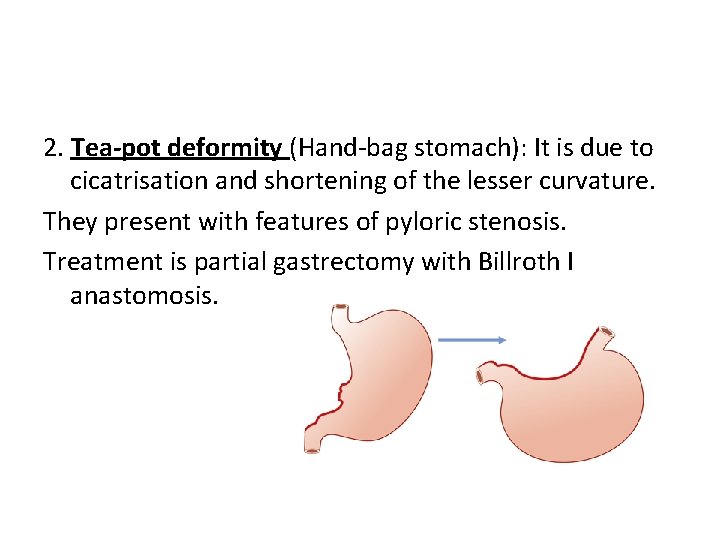 2. Tea-pot deformity (Hand-bag stomach): It is due to cicatrisation and shortening of the