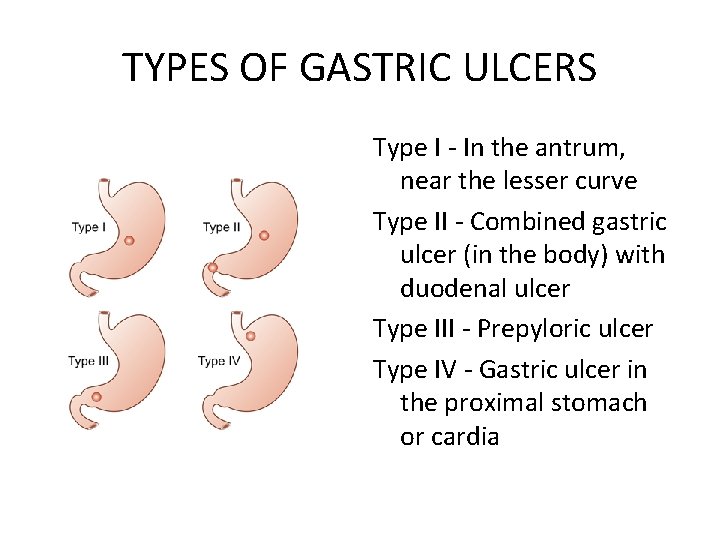 TYPES OF GASTRIC ULCERS Type I - In the antrum, near the lesser curve