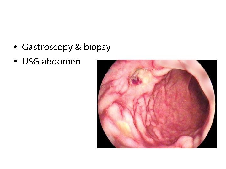  • Gastroscopy & biopsy • USG abdomen 